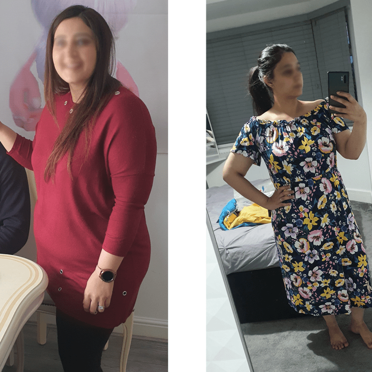 Before and after photos of a woman after undergoing weight loss