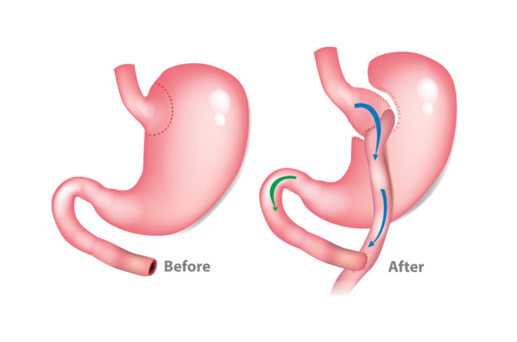 Illustration showing how the stomach works before and after a gastric bypass