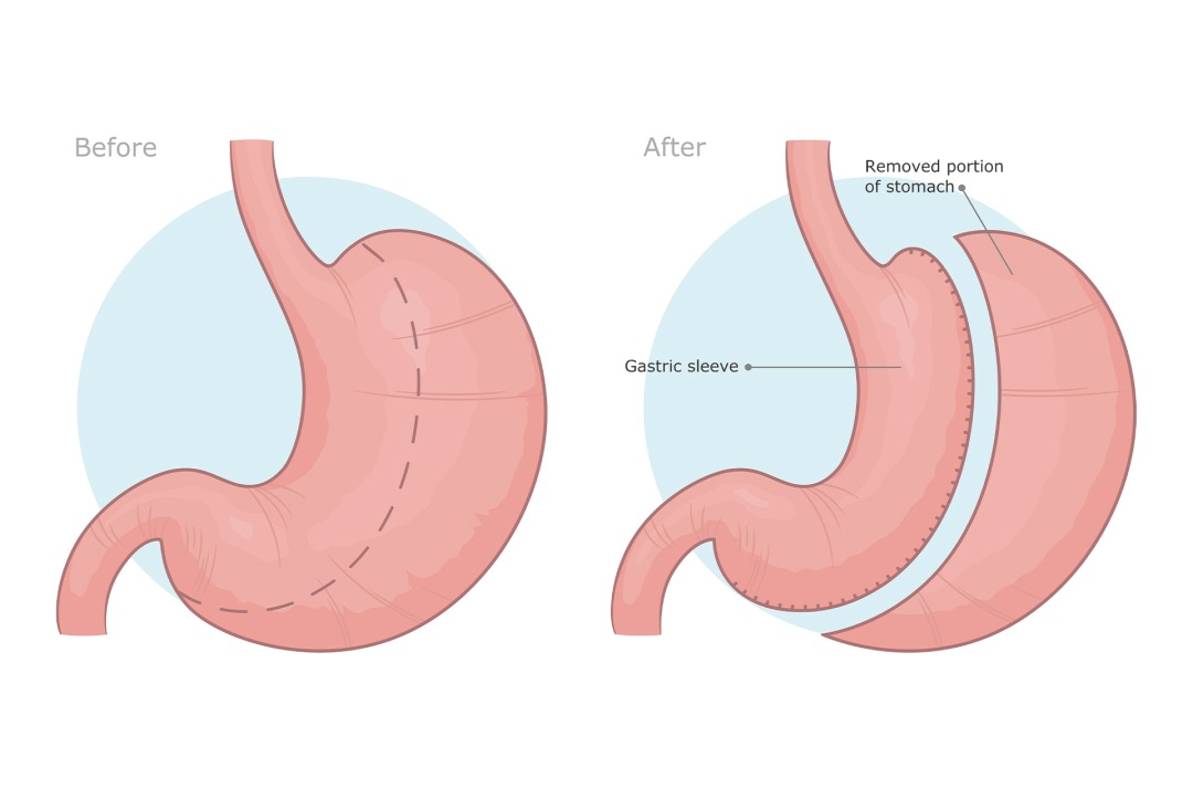 Illustration to demonstrate what is done to the stomach during a gastric sleeve procedure